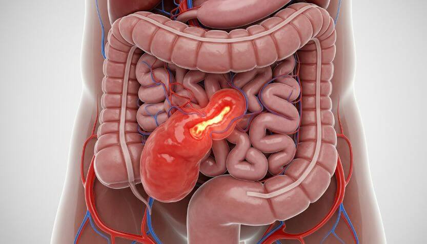 How to Identify the Early Symptoms of_Appendicitis