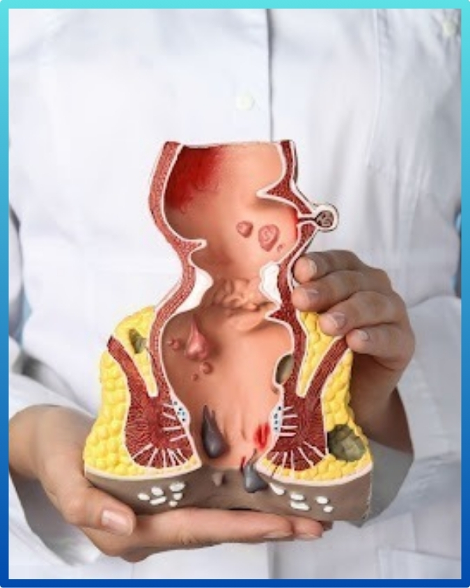 laser hemorrhoid surgery