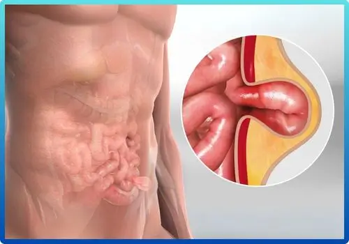 trusted Hernia Specialist in Bhubaneswar