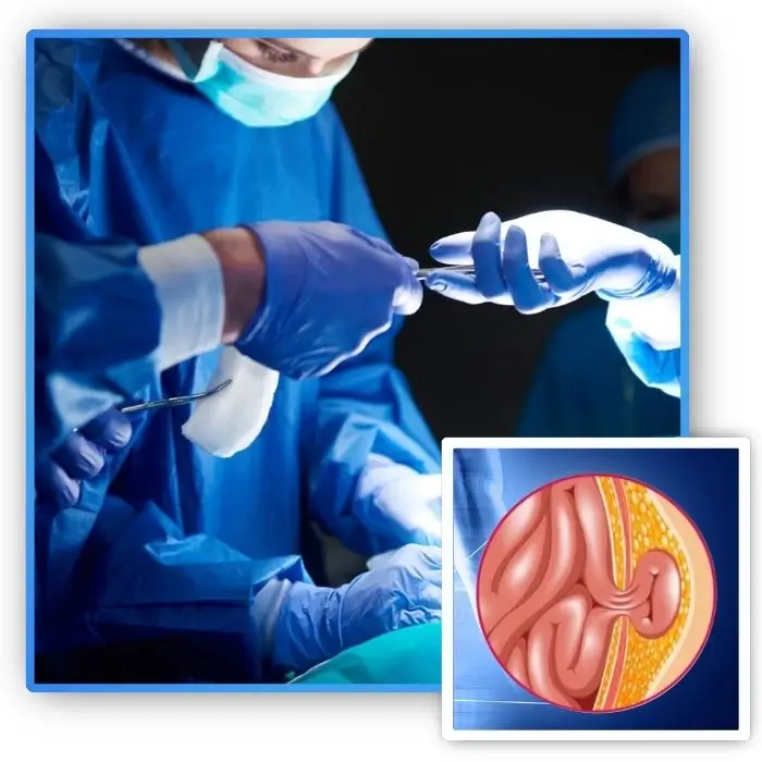 hernia surgery in Bhubaneswar By Dr. Lalatendu Mahapatra